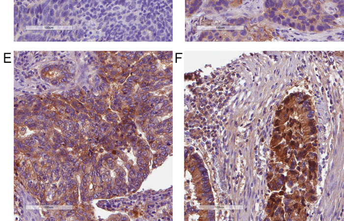 Publication on elevated complement factor I expression in lung cancer cells